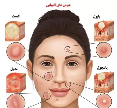 انواع جوش التهابی