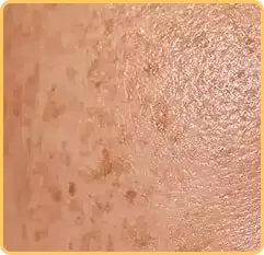 پوست لک دار