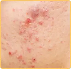 جوش های التهابی