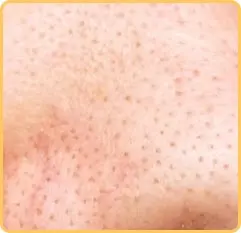 جوش های سرسیاه سرسفید