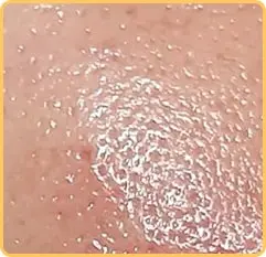 پوست چرب و براق