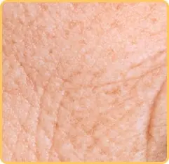 پوست های چروک